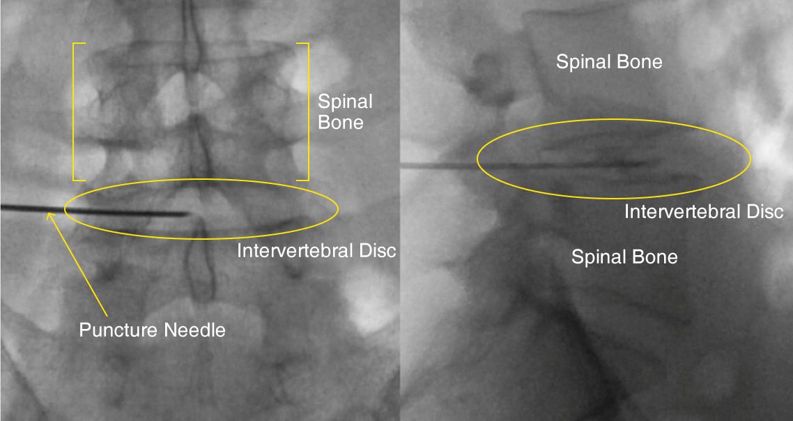 Cellgel treatment X-ray fluoroscopic image 1