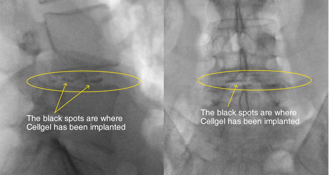 ILC's Treatment for Lumbar Compression Fracture