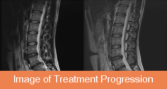 Progress image of PLDD treatment