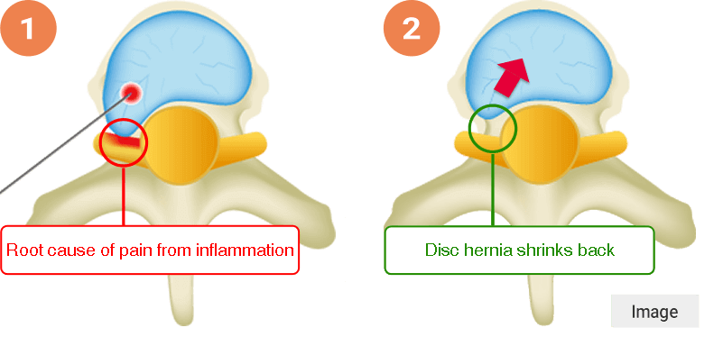 Herniated disc laser ablation image