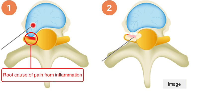 Herniated disc laser ablation image