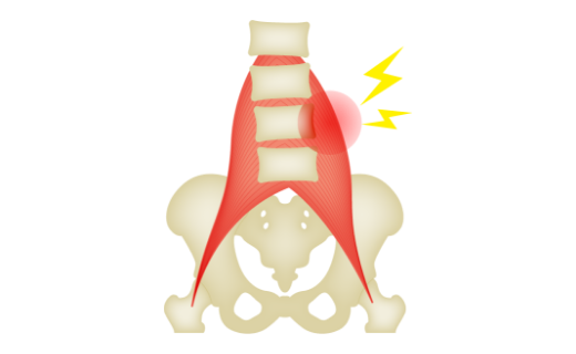 Myofascial Back Pain Image