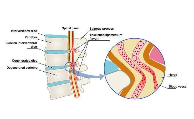 脊柱管狭窄症の原因の図