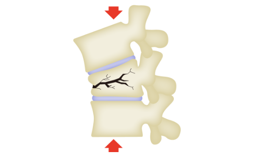 Lumbar Compression Fracture Image