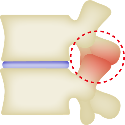 椎間関節症のイメージ