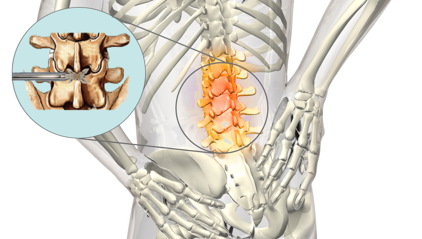 Lower back pain when applying the Florence method