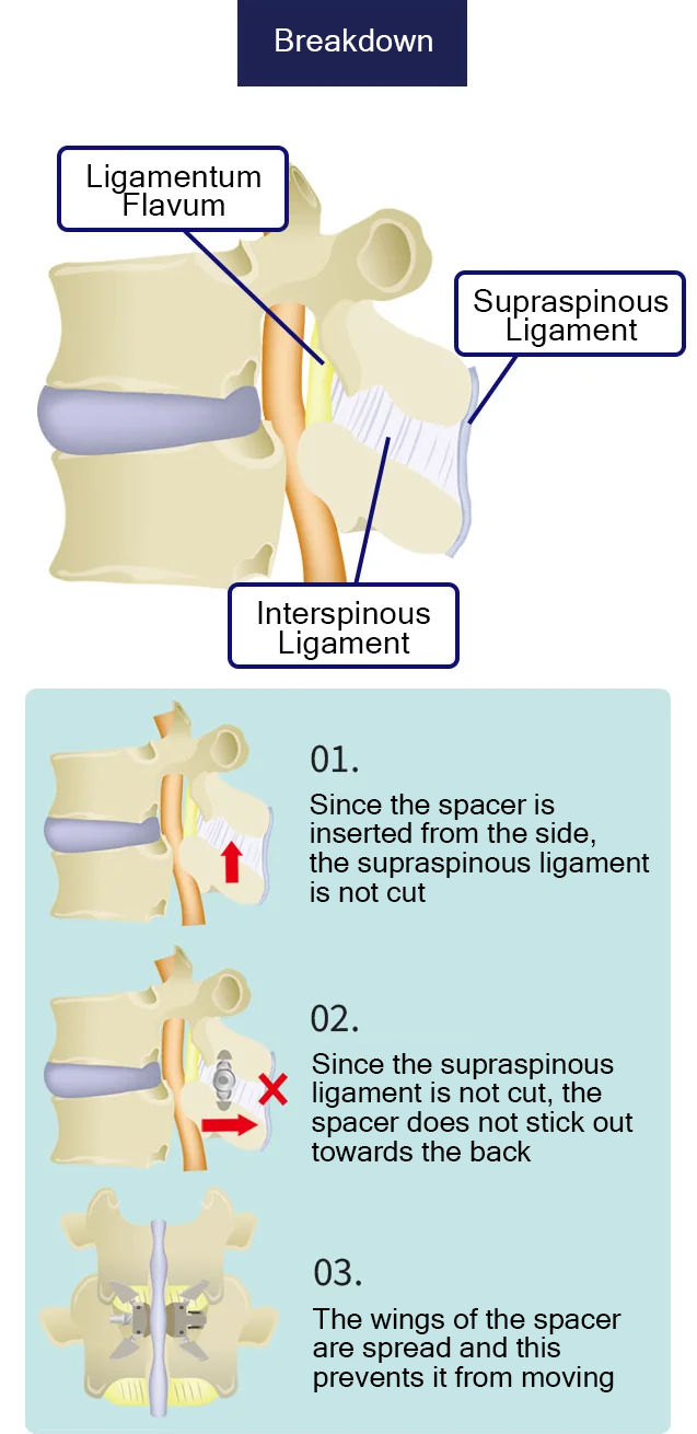 Illustration of inserting an implant