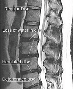 Causes of disc herniation Image