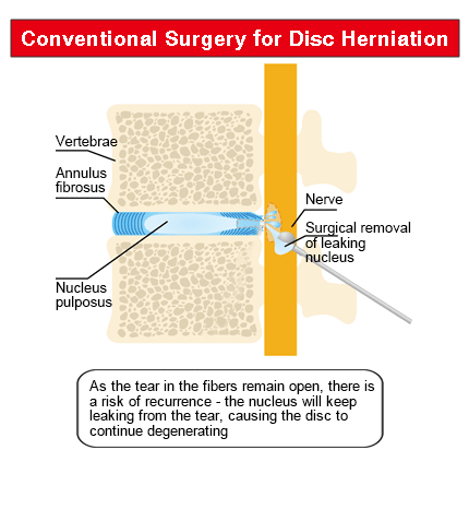 herniated disc causes pain Image