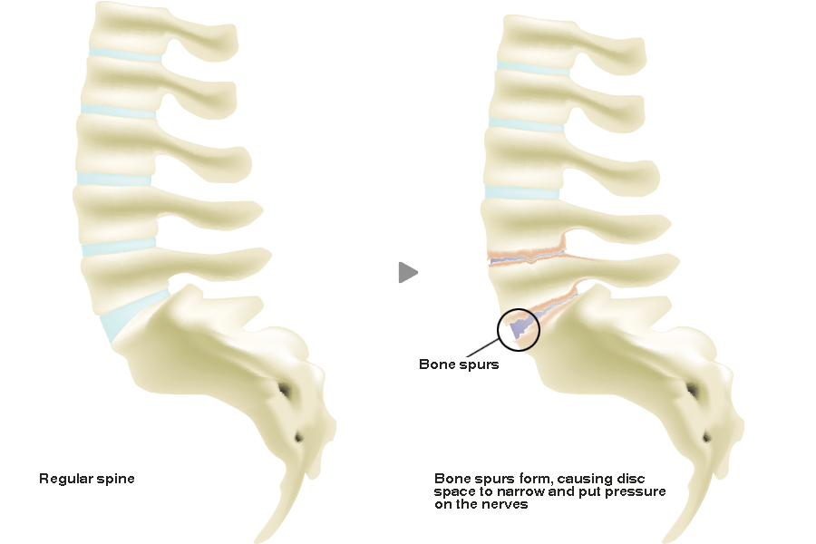 intervertebral disc