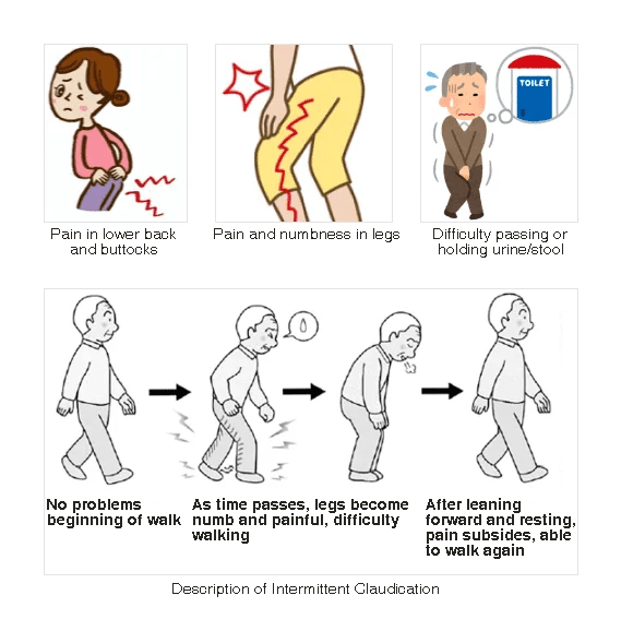 Image of main symptoms of spondylolisthesis