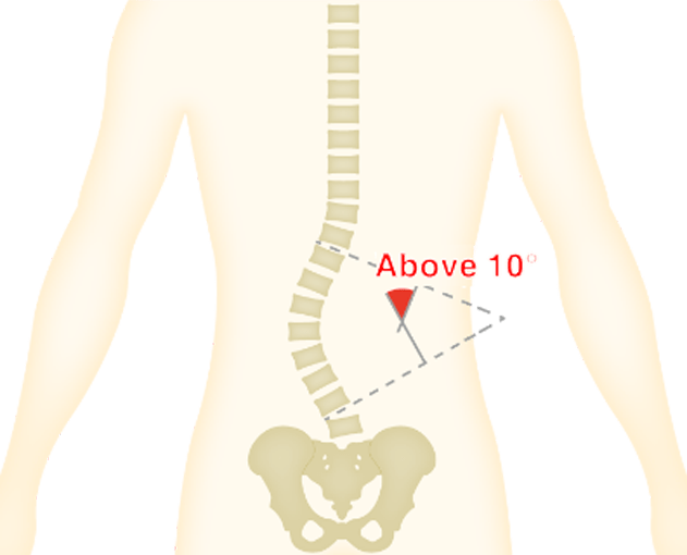 Image of lumbar degenerative scoliosis