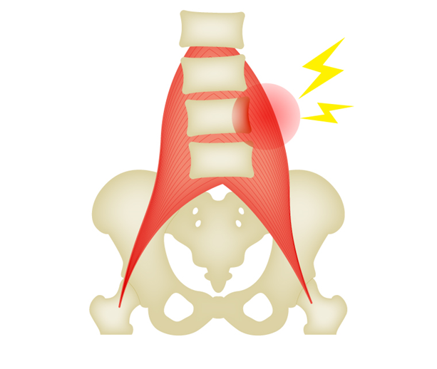 Image of muscle/fascial low back pain