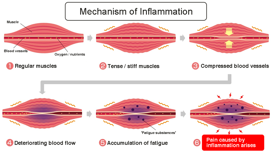 Illustration of the causes of myofascial low back pain