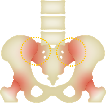 Image of sacroiliac joint disorder