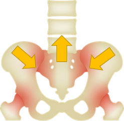 Illustration of low back pain