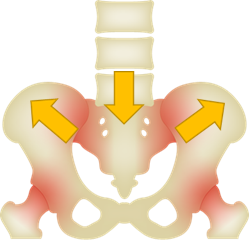 Illustration of low back pain