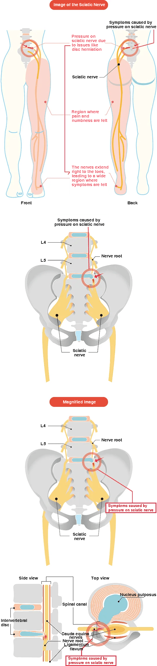 Image of sciatic nerve