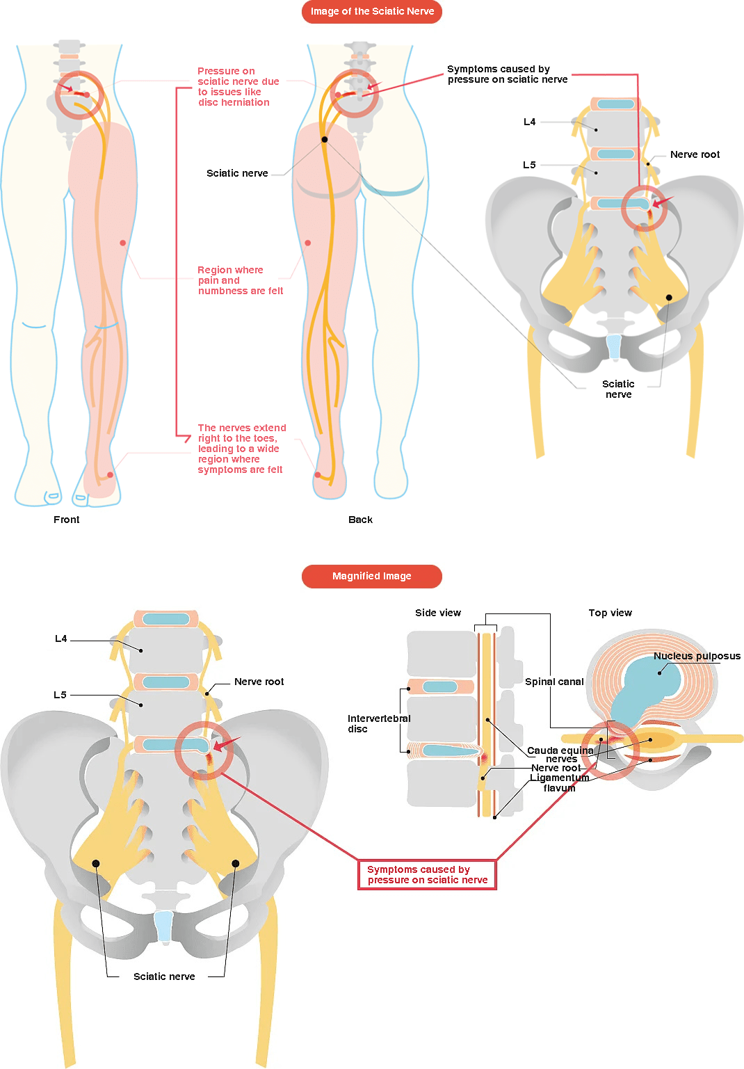 Image of sciatic nerve