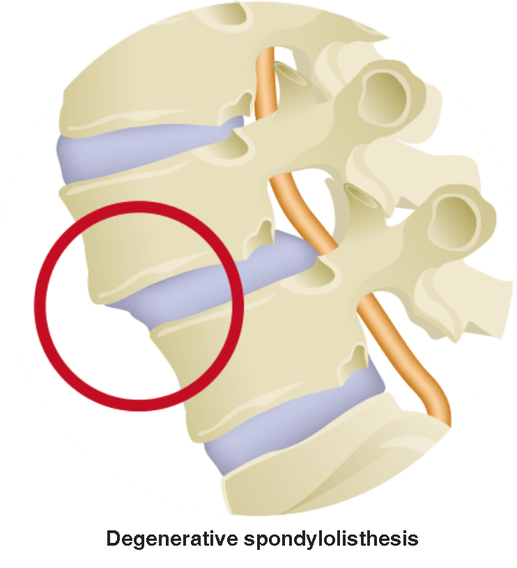 degenerative spondylolisthesis