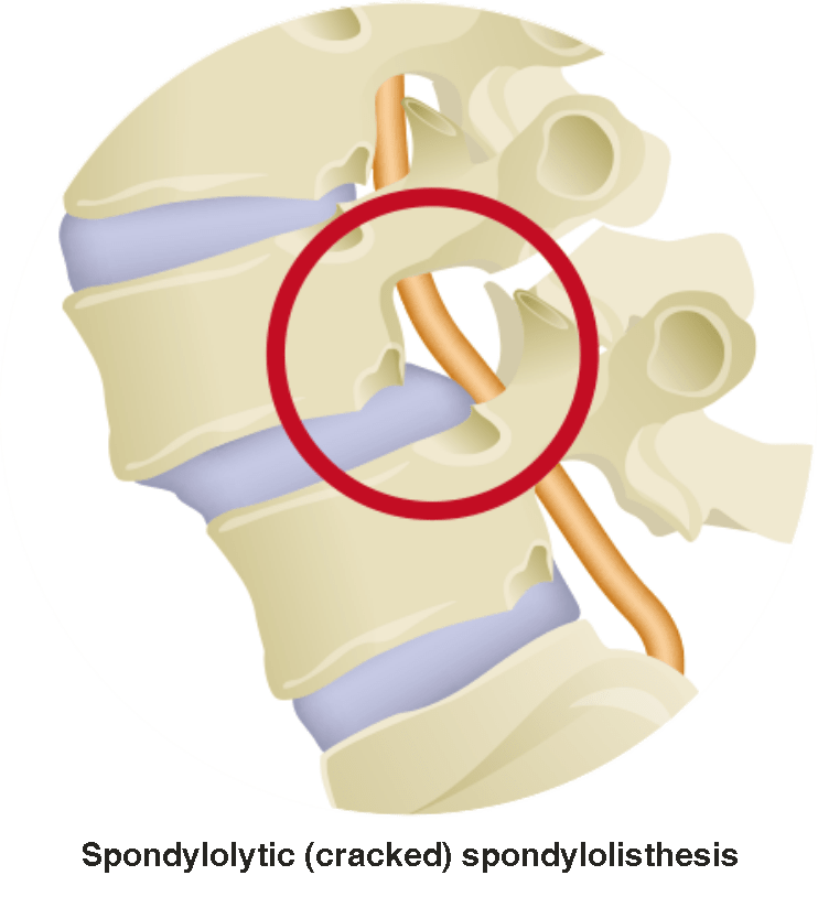 Spondylolisthesis