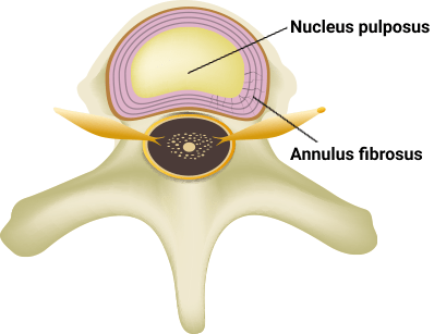Lumbar disc herniation image