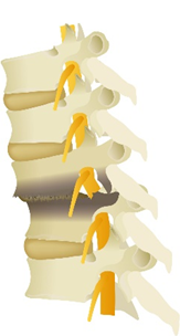 Intervertebral disc injury image