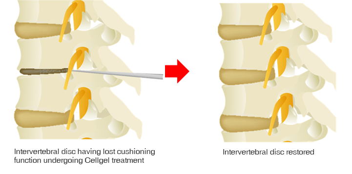 Treatment image of the cell-gel method