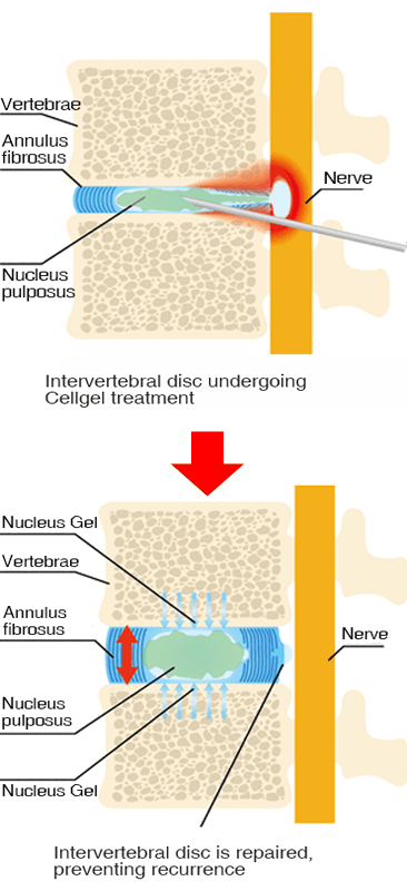 Treatment image of the cellgel method