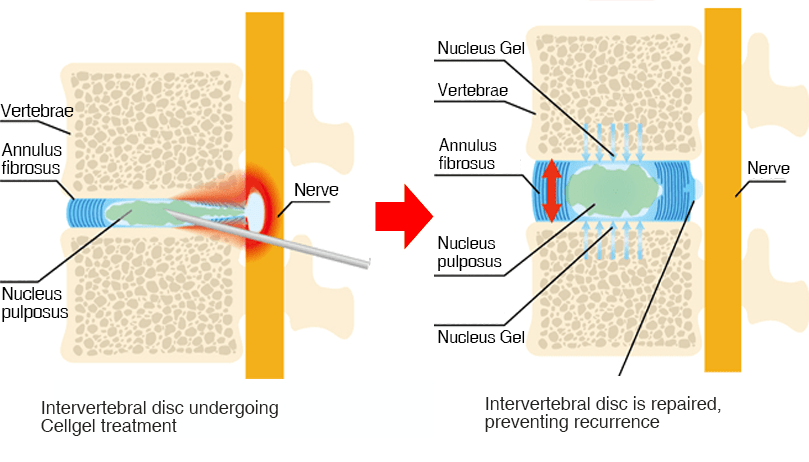 Treatment image of the cell-gel method