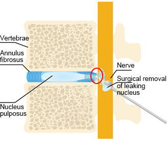 Conventional Surgery image