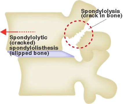 Image of Separation and Spondylolisthesis