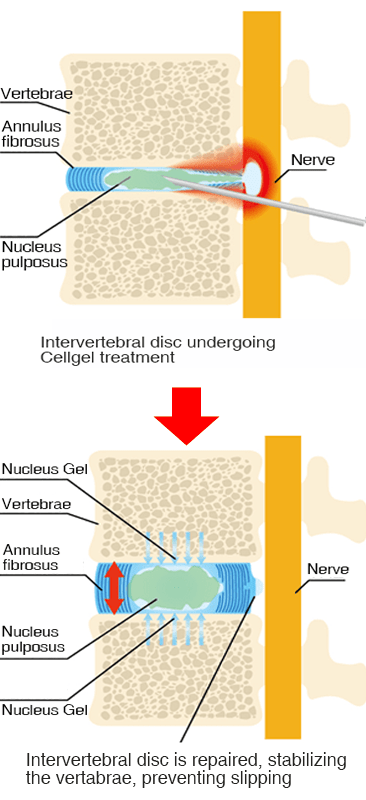 Treatment image of the cell-gel method