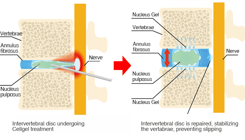 Treatment image of the cell-gel method