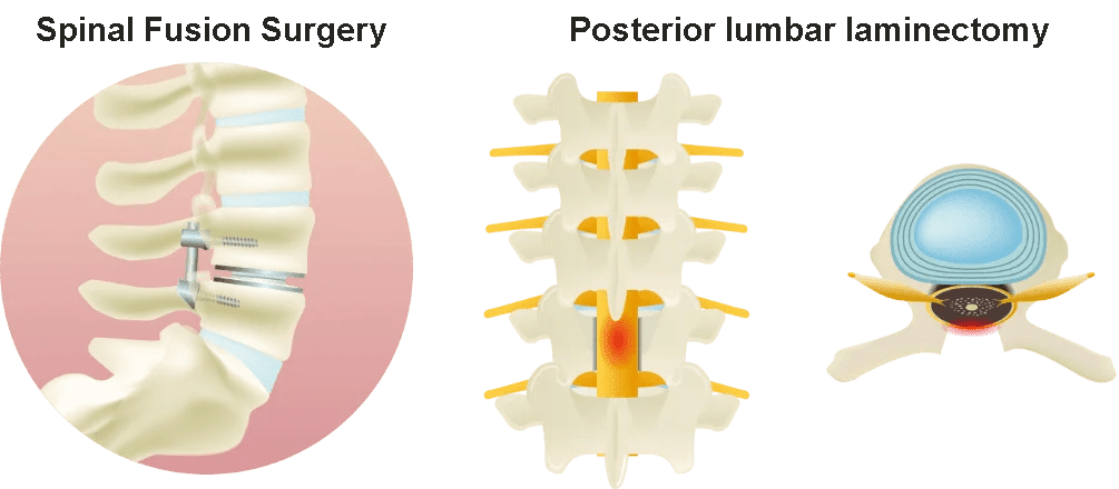 Conventional treatment image