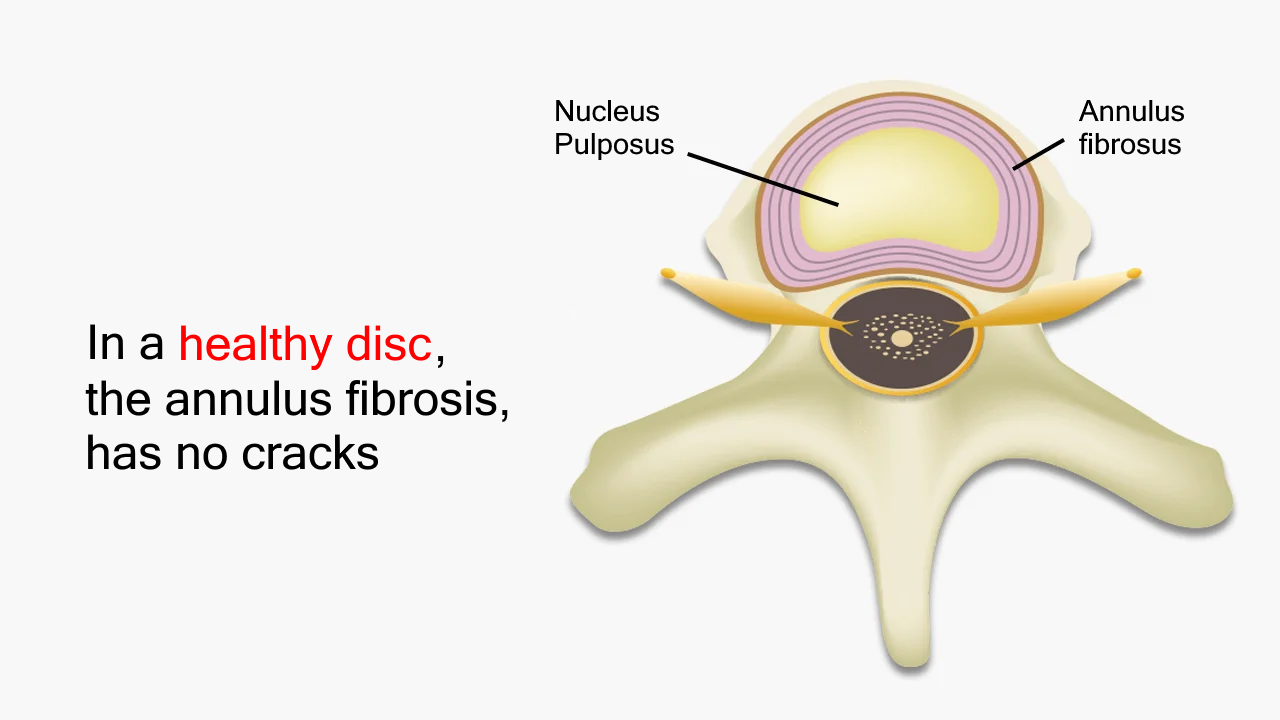 A normal disc has no fissures or cracks in the annulus fibrosus