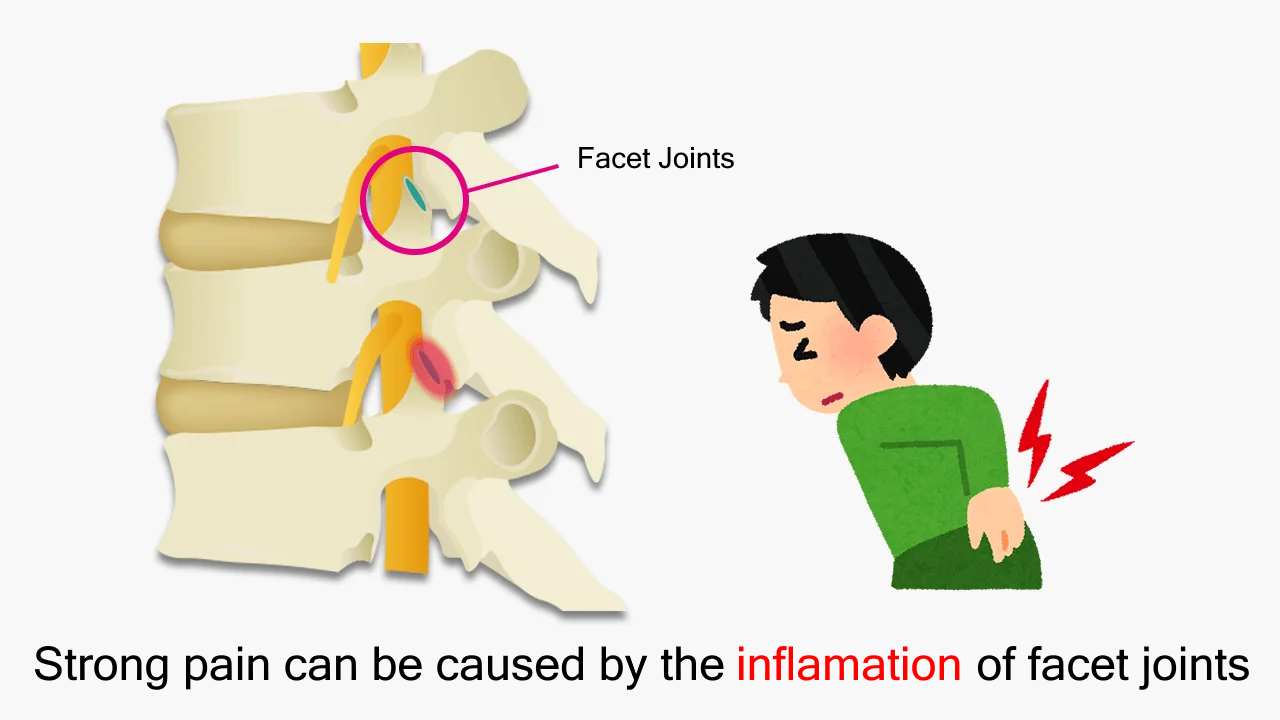 Severe pain caused by inflammation of the facet joints