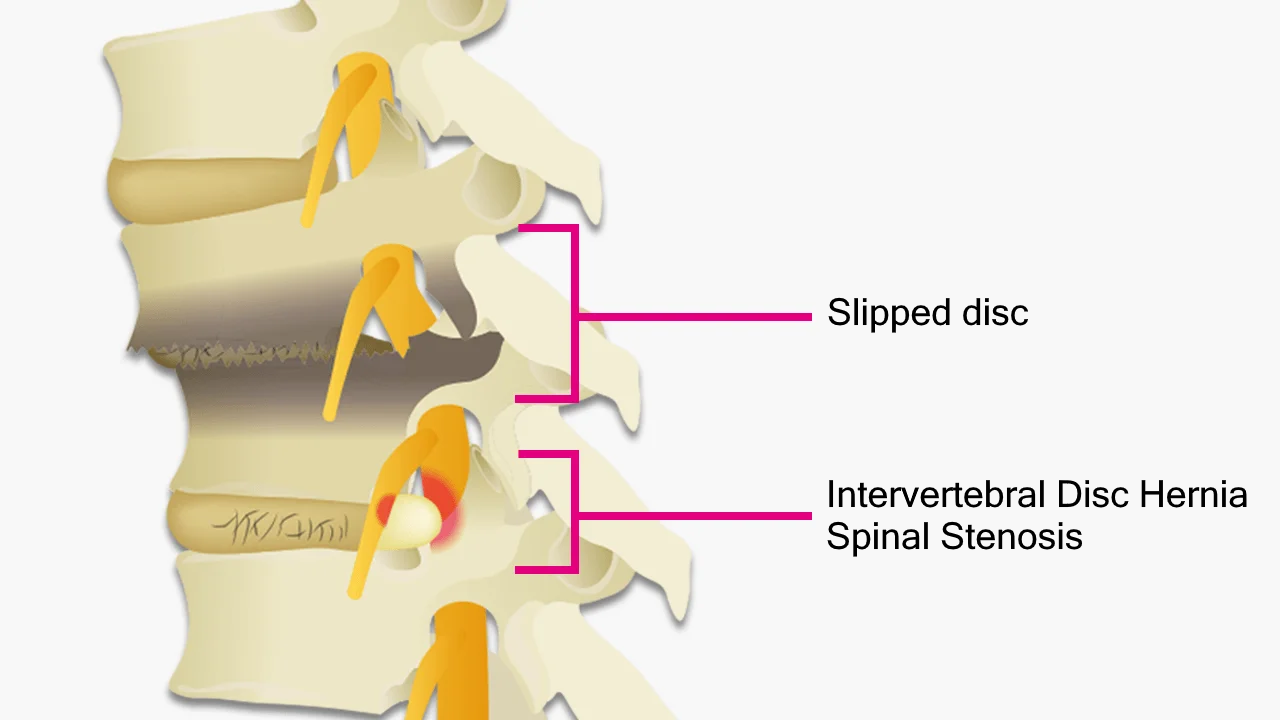 Spondylolisthesis, intervertebral disc herniation, spinal canal stenosis