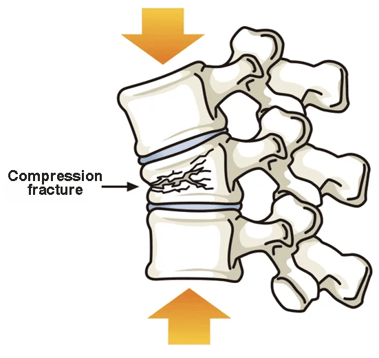 Image of lumbar compression fracture