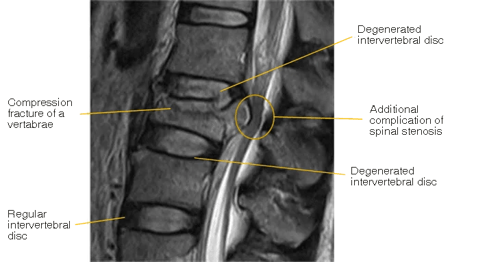 Lumbar compression fracture X-ray