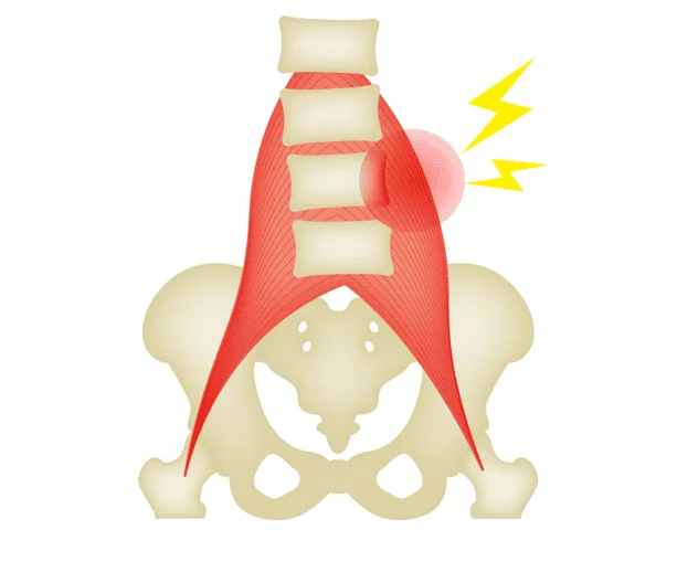腰の筋膜および筋肉の炎症による痛みの図