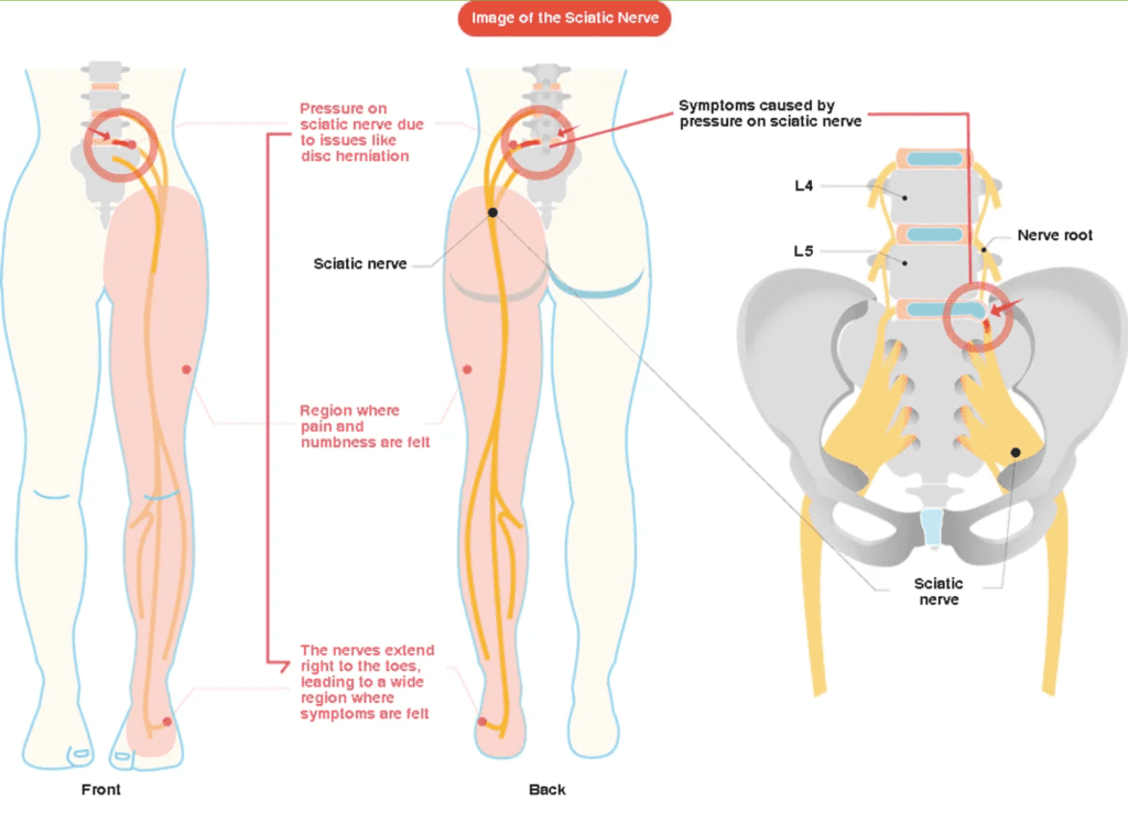 Disc Prolapse & Sciatica, Causes & Treatment