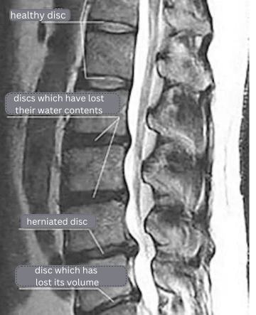 What Causes Herniated Discs?