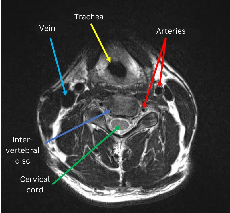 How to look at a MRI scan of the cervical spine International Lumbago