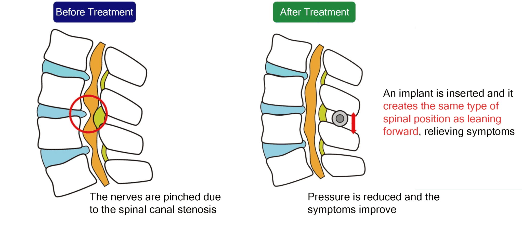 Five Stretching Exercises That are Effective for Lumbar Spinal Stenosis ...
